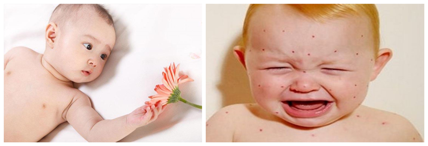 兒童濕疹反反復復,您有在家安裝家用除濕產品嗎? 兒童濕疹反反復復,您有在家安裝家用除濕產品嗎?